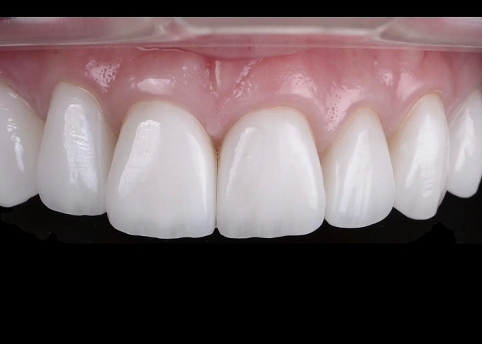 «Ортопедия от А до Я. Препарирование под: ВИНИРЫ, НАКЛАДКИ, КОРОНКИ e.max, циркониевые коронки, металлокерамику»