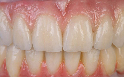 «Конструкции на имплантатах. Винтовая фиксация при тотальном протезировании. Условно-съёмные конструкции и работы на мультиюнитах»