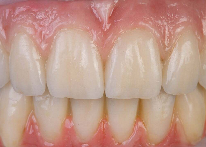 «Конструкции на имплантатах. Винтовая фиксация при тотальном протезировании. Условно-съёмные конструкции и работы на мультиюнитах»