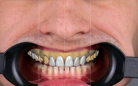 «Моделирование функции и эстетики в программе Exocad»