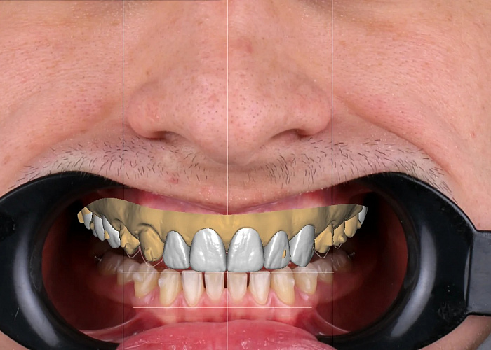 «Моделирование функции и эстетики в программе Exocad»