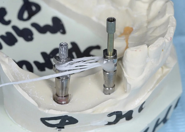 Дентальные протоколы работы с имплантатами. Взаимодействие хирурга и ортопеда