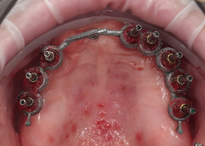 «Ошибки планирования при тотальном протезировании и пути их решения»