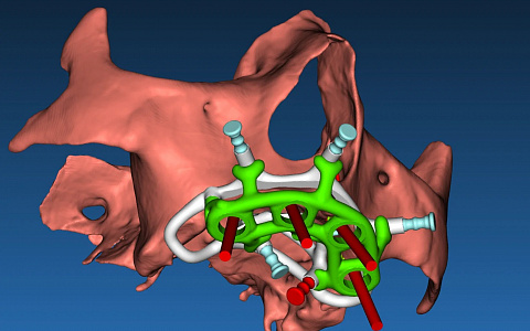 «Хирургические шаблоны и немедленная нагрузка»