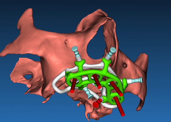 «Хирургические шаблоны и немедленная нагрузка»