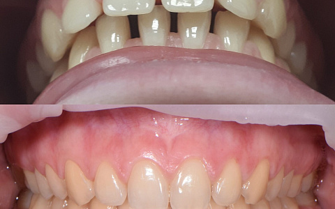 «Как спасти свои зубы после лечения ВНЧС»