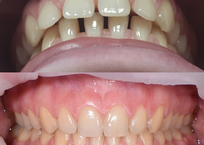 «Как спасти свои зубы после лечения ВНЧС»