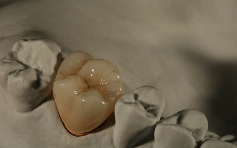 «Циркониевые виниры существуют?! И действительно ли диоксид циркония меньше керамики стирает свои зубы?»