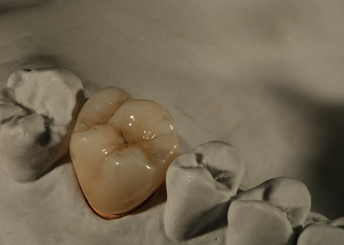 «Циркониевые виниры существуют?! И действительно ли диоксид циркония меньше керамики стирает свои зубы?»