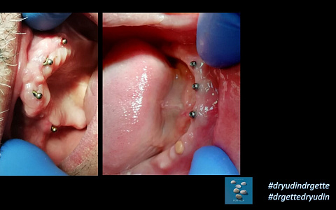 «Тотальная реабилитация на примере съемных протезов»