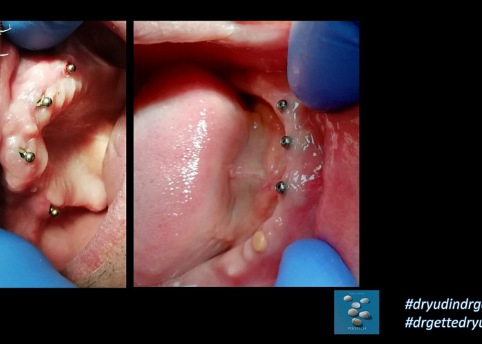 «Тотальная реабилитация на примере съемных протезов»