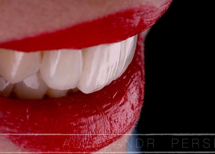 «Эстетическая реабилитация пациента при помощи виниров»