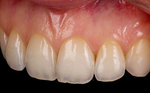 «Демонстрация препарирования под виниры на примере живого пациента!»