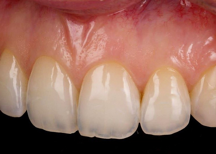 «Демонстрация препарирования под виниры на примере живого пациента!»