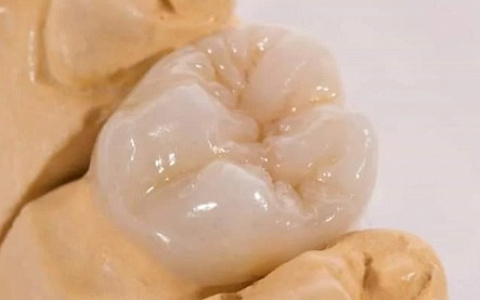 «Новые возможности прессованной керамики. Мостовидные протезы. Дисиликат лития упрочненный диоксидом циркония»