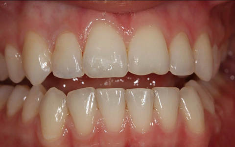 Особенности изготовления ультратонких виниров без препарирования