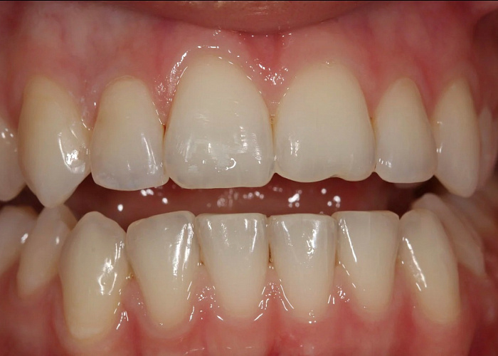 «Особенности изготовления ультратонких виниров без препарирования»