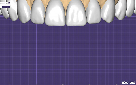 «Работа в exocad. Цифровой протокол протезирования»