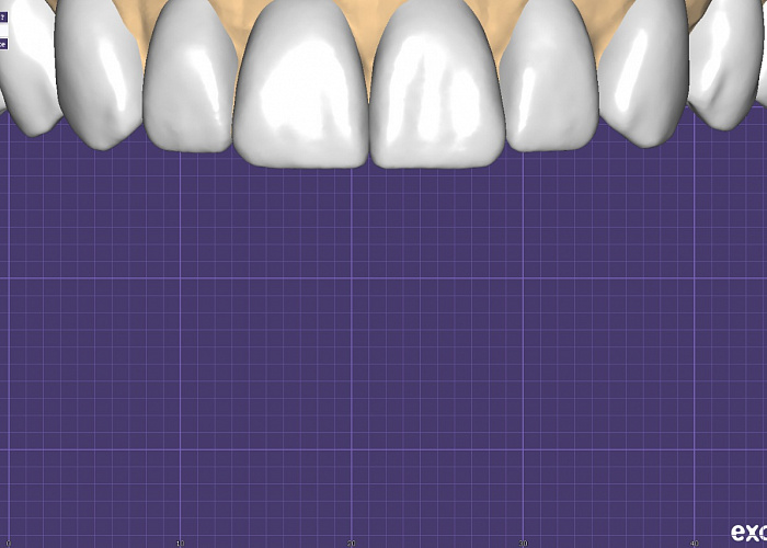 «Работа в exocad. Цифровой протокол протезирования»