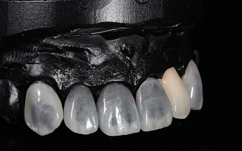 «Создание ультратонких виниров на рефракторе из керамической массы Duceram Kiss + коронка e.max Ceram на основе диоксида циркония на имплантате»