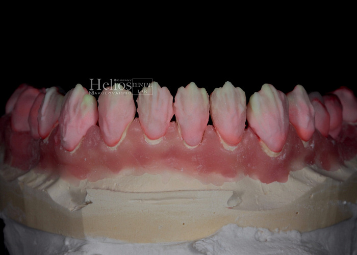 «Основные лайф-хаки виниров e.max. Как уйти от серости»