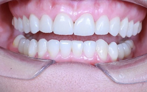 «Ортодонт и хирург: Минивинты и имплантация – командная работа для максимального результата»