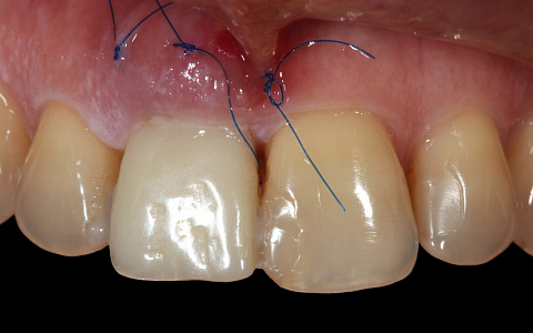 «Альтернативная ортопедия. Протезирование на имплантатах»