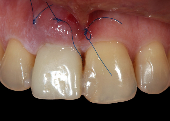 «Альтернативная ортопедия. Протезирование на имплантатах»