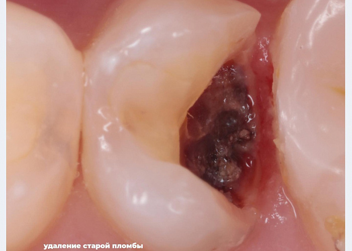 «Художественная и функциональная реставрация. Жевательная + фронтальная группы зубов»