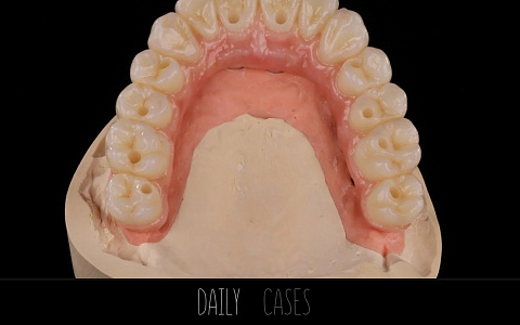 «Протокол тотального протезирования при полной адентии»