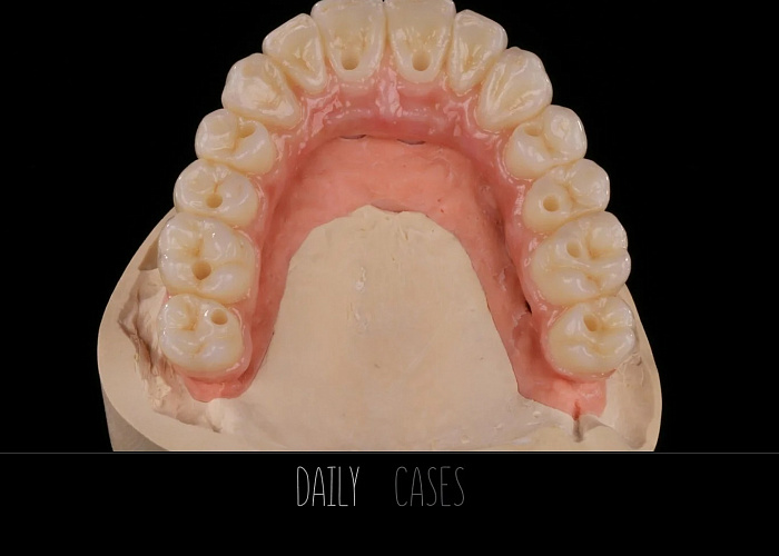 «Протокол тотального протезирования при полной адентии»