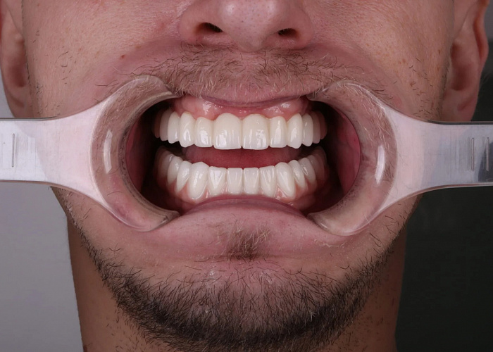 «Тотальная реабилитация на multi-unit абатментах в полном цифровом протоколе. Живая демонстрация на пациенте»