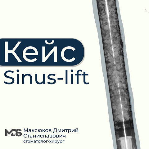 Обширный синус-лифтинг с дефектом альвеолярного отростка
