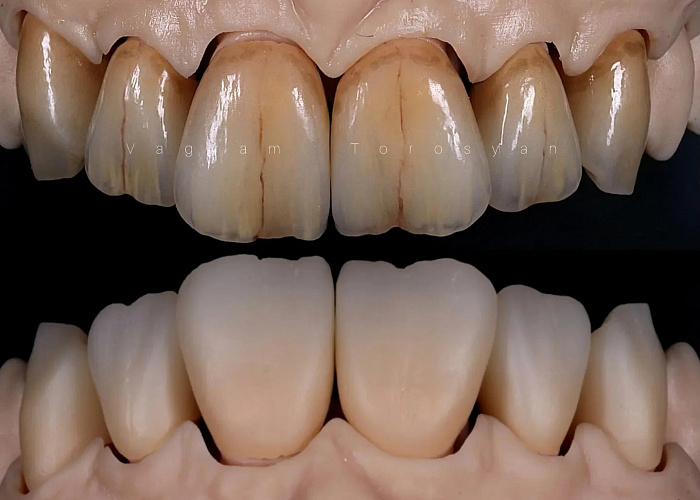 Симметрия формы и цвета. Живая эстетика и индивидуализация в полно анатомических конструкциях из диоксида циркония»