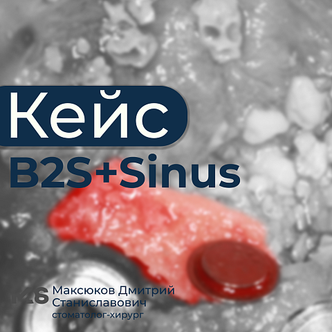Синус-лифтинг + B2S