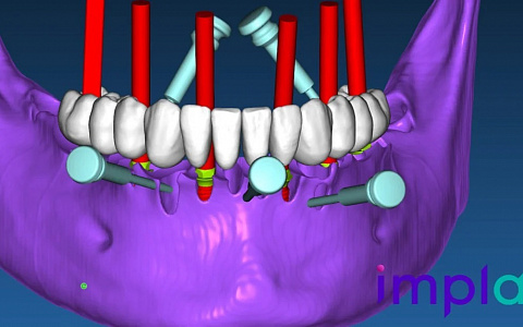 «Создание неразборных хирургических шаблонов в RealGuide. От планирования до 3-D печати»