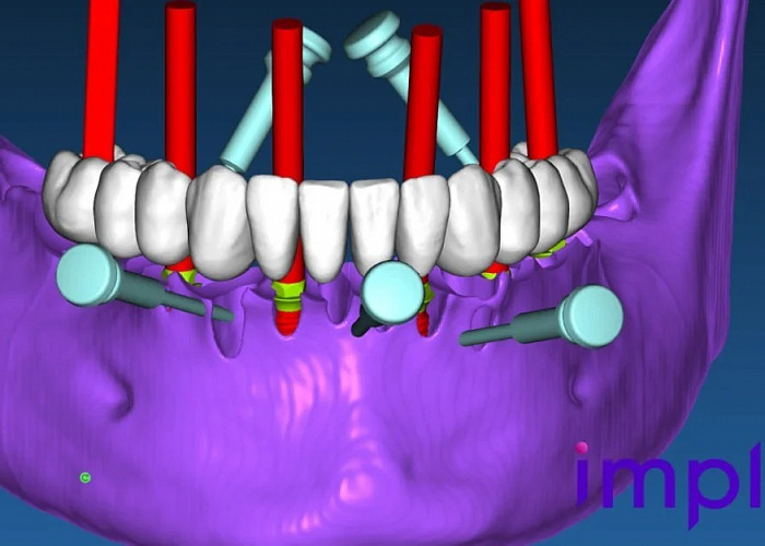 «Создание неразборных хирургических шаблонов в RealGuide. От планирования до 3-D печати»