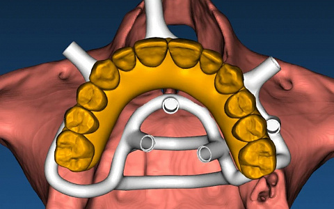 «Создание неразборных хирургических шаблонов в RealGuide. От планирования до 3-D печати»