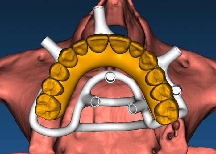 «Создание неразборных хирургических шаблонов в RealGuide. От планирования до 3-D печати»
