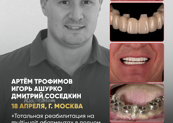 «Тотальная реабилитация на multi-unit абатментах в полном цифровом протоколе. Живая демонстрация на пациенте»