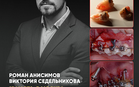 «Ортодонт и хирург: Минивинты и имплантация – командная работа для максимального результата»