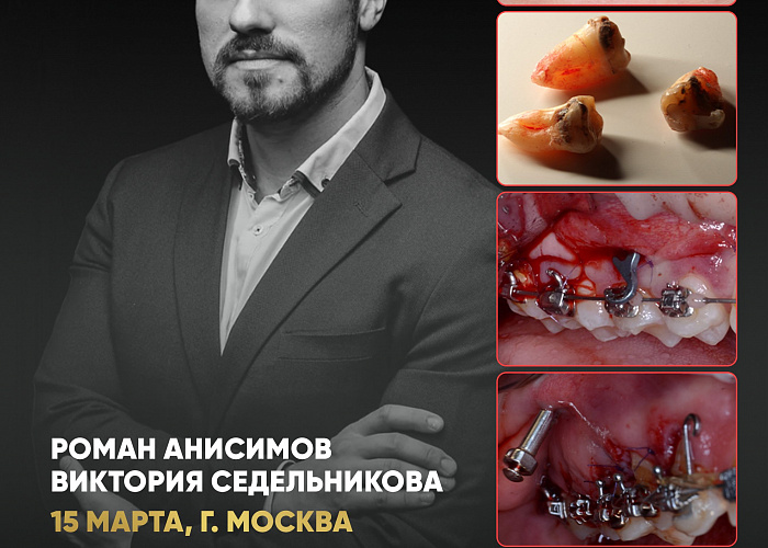 «Ортодонт и хирург: Минивинты и имплантация – командная работа для максимального результата»