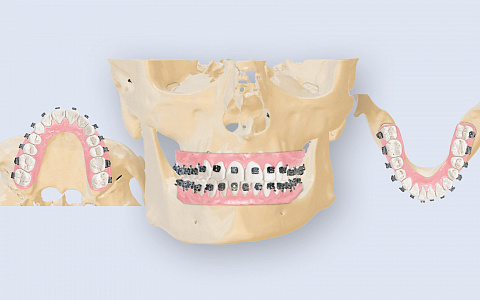 Непрямая фиксация брекетов