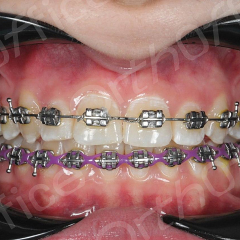 Клинический случай OrthOffice (Ортофис)