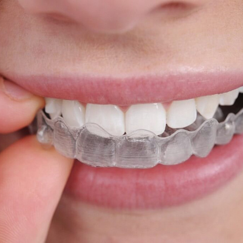 Сроки лечения на элайнерах Invisalign сокращаются