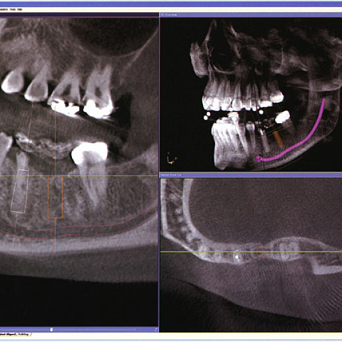 Снимок зубов 3D