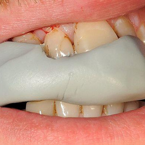 Реставрация 11 и 12 зуба с изменением вертикальной оси 11 зуба