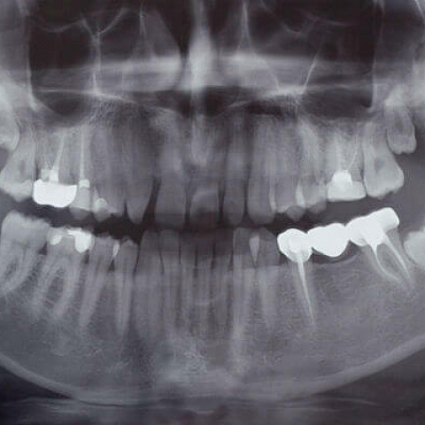 Ортопантомограмма - панорамный снимок зубов
