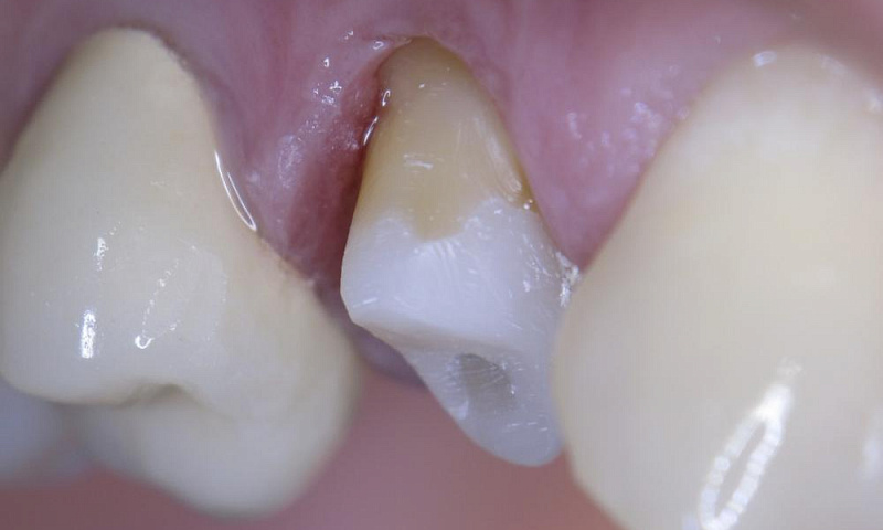 Методики наращивания зубов