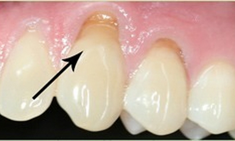 Что такое клиновидный дефект зуба?